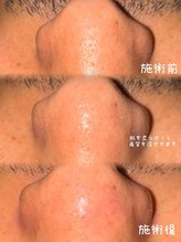 アクシア ビューティー サロン(AXSIA)/【ハイドラフェイシャル】