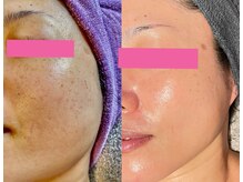 ピュアグレース 自由が丘/40代前半のお客様フルコース6回