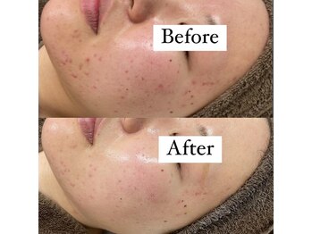 カルディエ(Cardie)/肌質改善　ビフォーアフター