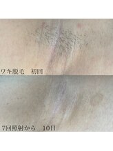 トリップ(trip)/お肌が変わる美肌脱毛♪