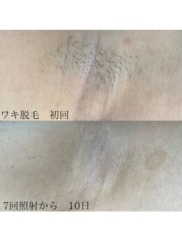 トリップ(trip)/お肌が変わる美肌脱毛♪