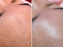 レネットサロン(Reinette Salon)/お顔ワックス&ハイドロジェリー