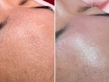 レネットサロン(Reinette Salon)/お顔ワックス&ハイドロジェリー