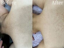 ミスティア(mistia)/美肌脱毛【背中】After/2回照射