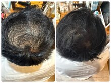 エミュ(emu)/水光頭皮　beforeafter写真2