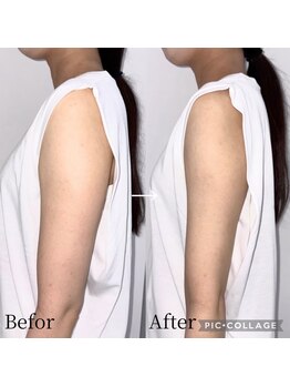 カンナムビューティーの写真/【二の腕最強痩身】最強痩身リフトでたるみを徹底引き締め!理想のほっそり美腕へ