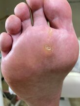 フットメンテ 巻き爪矯正センター 南浦和/魚の目　施術前
