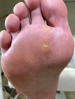 フットメンテ 巻き爪矯正センター 南浦和/魚の目　施術前