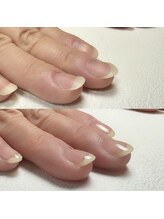 ネイル アンチュ(Nail Anchu)/自爪育成／反り爪・わし爪