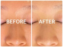 ハーブピーリング 心斎橋/ハーブピーリングで毛穴ケア