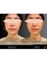 チョコバリ 錦糸町店(chocobari)/小顔×リフトアップ(美容鍼)20代