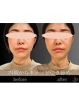 チョコバリ 錦糸町店(chocobari)/小顔×リフトアップ(美容鍼)20代