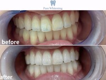 ピュアホワイトニング 横浜店