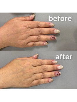 ハンドケアビフォーアフター