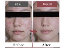 フルリール/【ニキビケアプロテクション】