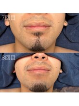 カナウ(KANAU)/ヒゲ脱毛（20代前半男性）