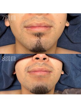 カナウ(KANAU)/ヒゲ脱毛（20代前半男性）
