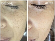 ホワイトアクア 四日市店(WHITE AQUA)/50代エステできれいに