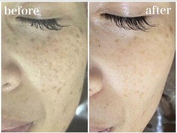 ホワイトアクア 四日市店(WHITE AQUA)/50代エステできれいに