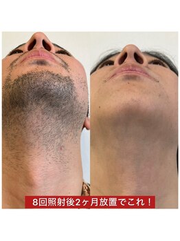 ディーバ 北堀江(DIVA)/髭脱毛で毎日の髭剃りから解放♪