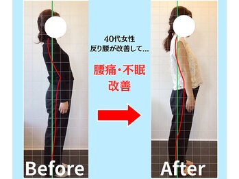 ソヴァール(SAUVEUR)/40代女性　反り腰からの腰痛不眠
