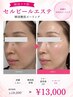 【毛穴・くすみ改善】皮むけなしの次世代型ピーリング¥19,200→¥13,000