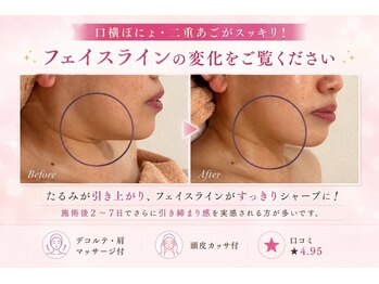 キャンディ 海老名駅前店(Candy)の写真/次世代最強小顔施術*マイクロ波リフト導入サロン◆二重/たるみ/もたつきに！脂肪減少・効果を即実感/オンダ
