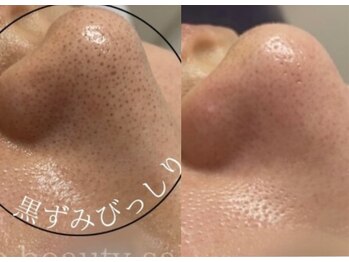 ホーミー(Homie)/毛穴黒ずみ、毛穴開き改善