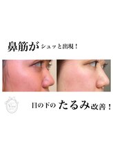 ヴィオール 名古屋栄店(VIOR)/水光 ハーブピーリング