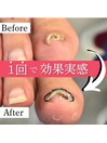 巻き爪矯正 変化