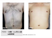 ザ エッセンシャル 碧南(THE Essential)/メンズ 胸＋お腹脱毛（Lパーツ）