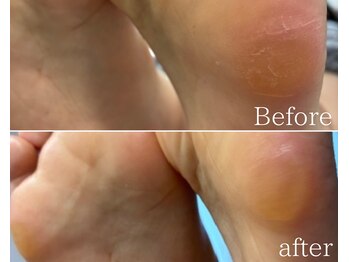 カシェット 広島店(Cachette)/30代女性☆足裏角質ケア60分