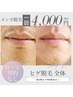 ヒゲ脱毛全体￥4000