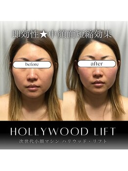 ブリリオプラス 四条烏丸店(Brillio plus)/ハリウッドリフト