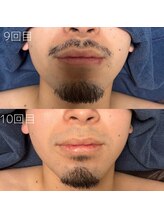カナウ(KANAU)/ヒゲ脱毛（20代前半男性）