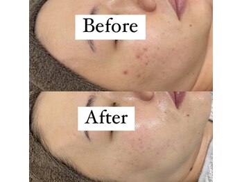 カルディエ(Cardie)/肌質改善　ビフォーアフター