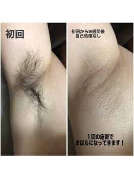 プライベートサロン アール(R)/MENS！ワキ脱毛