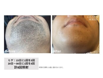 スプレール 水戸店/髭脱毛