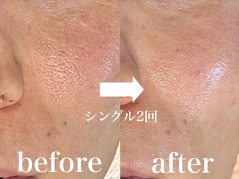 ルー ハナレ 神戸岡本 摂津本山店(Luu HANARE)/毛穴改善 開き毛穴 黒ずみ毛穴