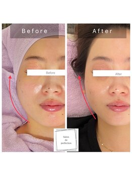 サロン ド パーフェクション(Salon de Perfection)/小顔リフト