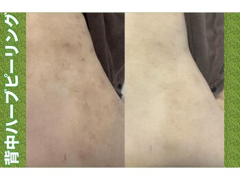 ブレア(Blair)/背中ピーリング1回