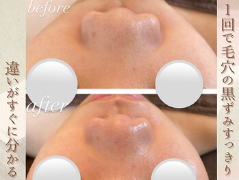 ラナ(LaNa)/毛穴ケア