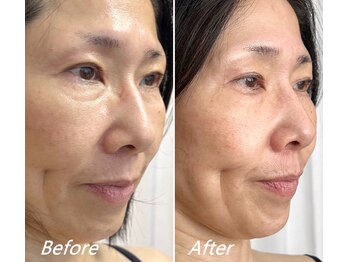 ドクターボディ 新宿店(Dr.Body)/【目の下のたるみ/輪郭 50代】