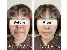 ベルシア(Belxia)/陶肌トリートメント症例