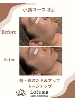 ルトゥーシア(Lotusia)/小顔　　before→after