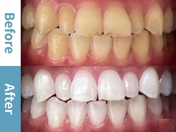 アース 岡崎店(EARTH)/【ビフォーアフター】美白