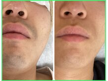 クリア 尾張旭店(Clear)/【Clear脱毛ビフォーアフター】