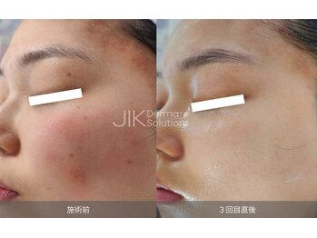 ナチュウル(Natulu)/ララピール進化版！ダクトピール