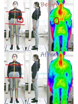 姫路なごみ整体院 なごみ鍼灸院/(改善例)腰痛・右首痛み・鼠径部