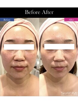 ファウンデーション(FOUNDATION)/高周波(小顔、リフトアップ)